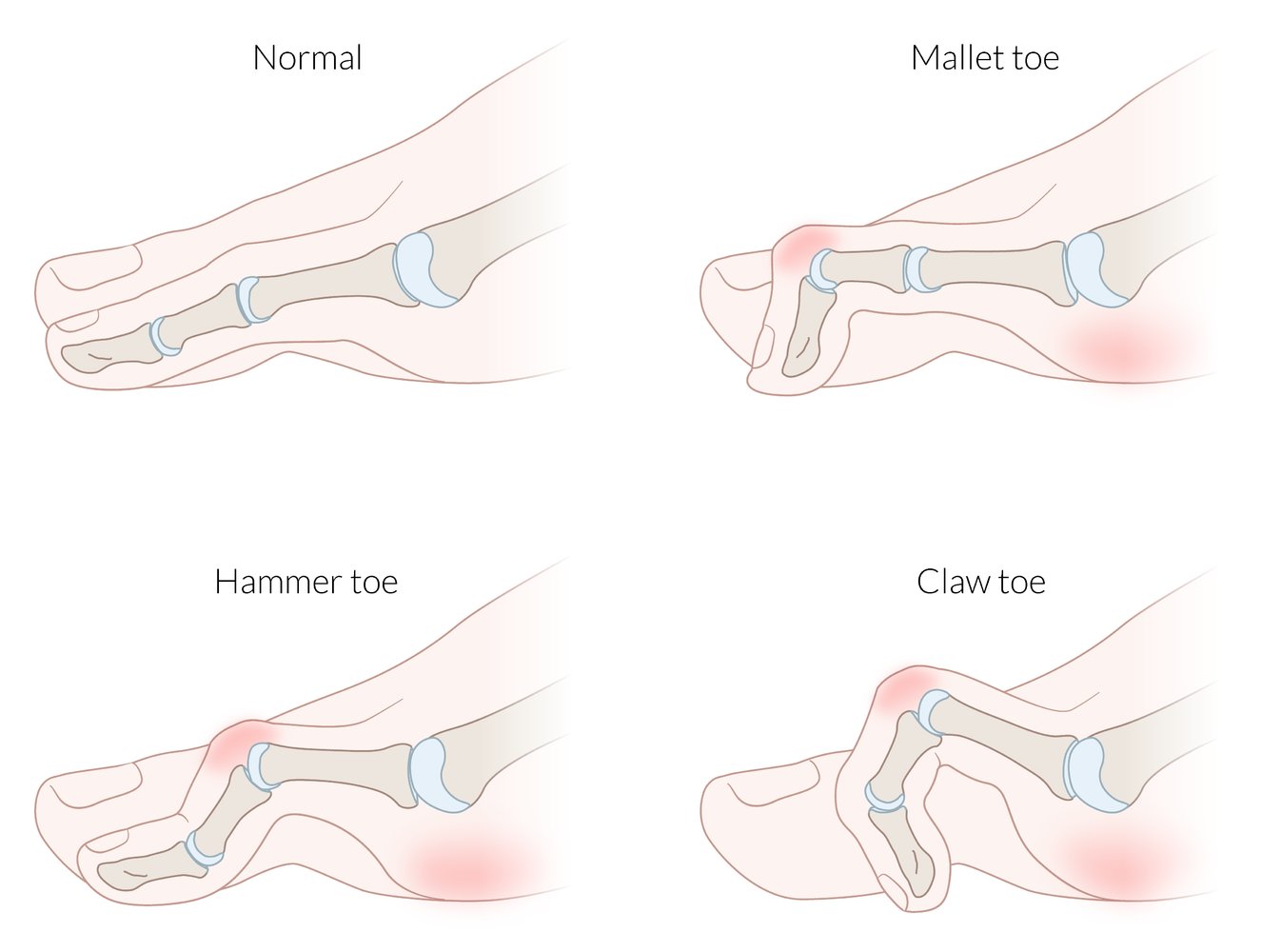 Hammer toe and claw toe