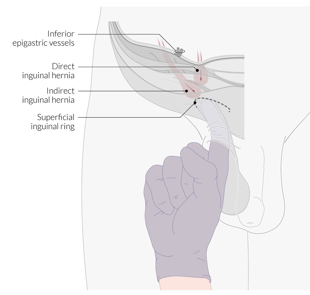 Palpation of the inguinal canal in a male patient