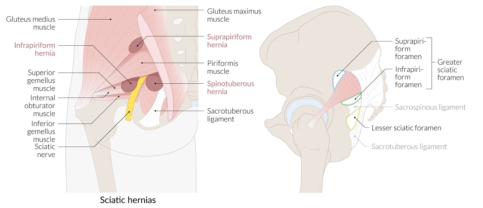 Sciatic hernias