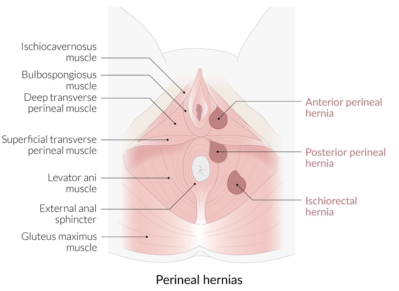 Perineal hernias