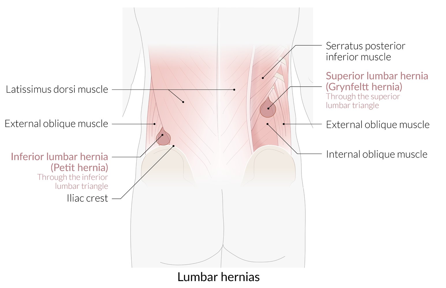Lumbar hernias