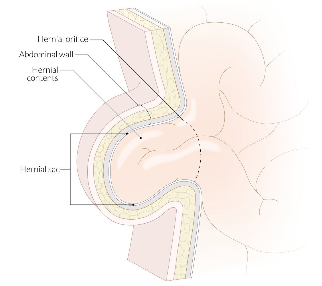 Components of an abdominal or inguinal hernia