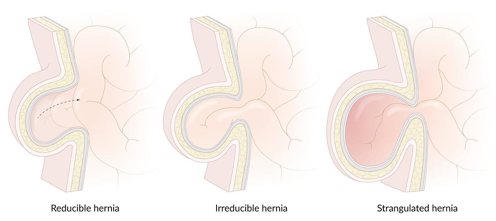Reducible, irreducible, and strangulated hernias