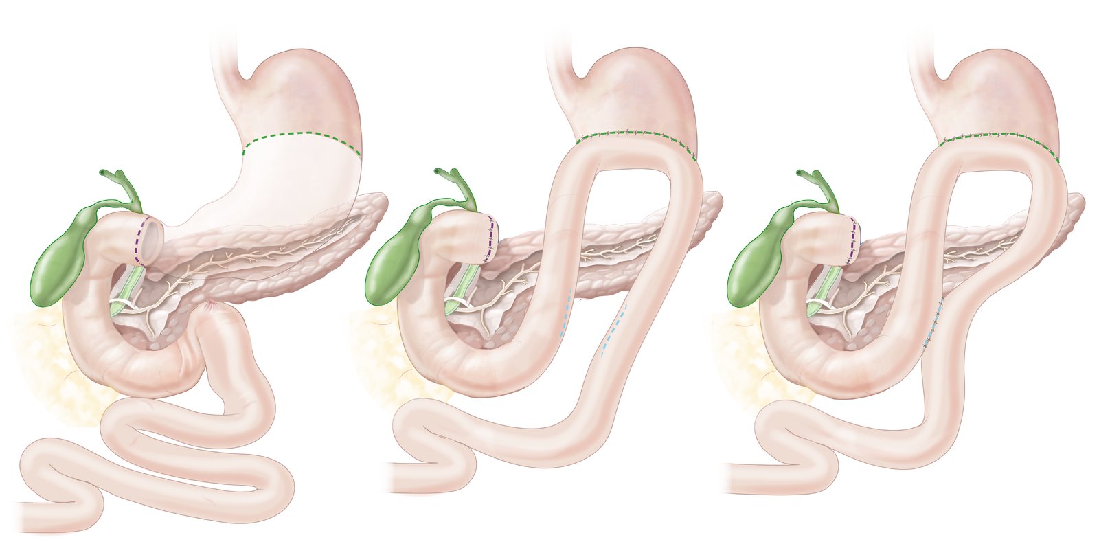 Partial gastrectomy (Billroth II)