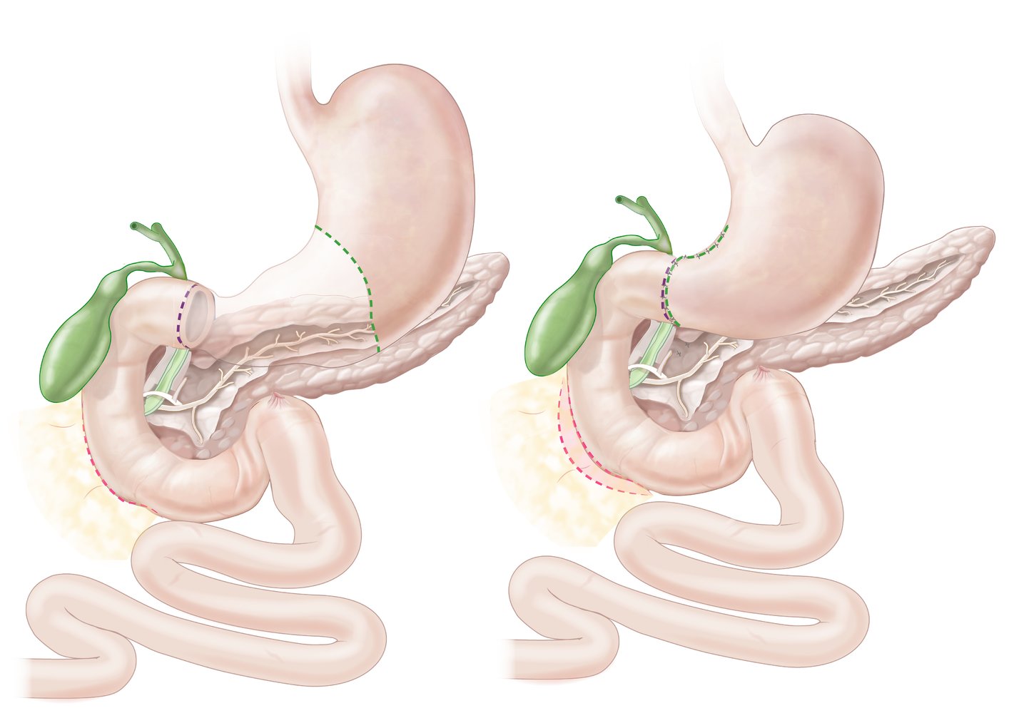 Partial gastrectomy (Billroth I procedure)