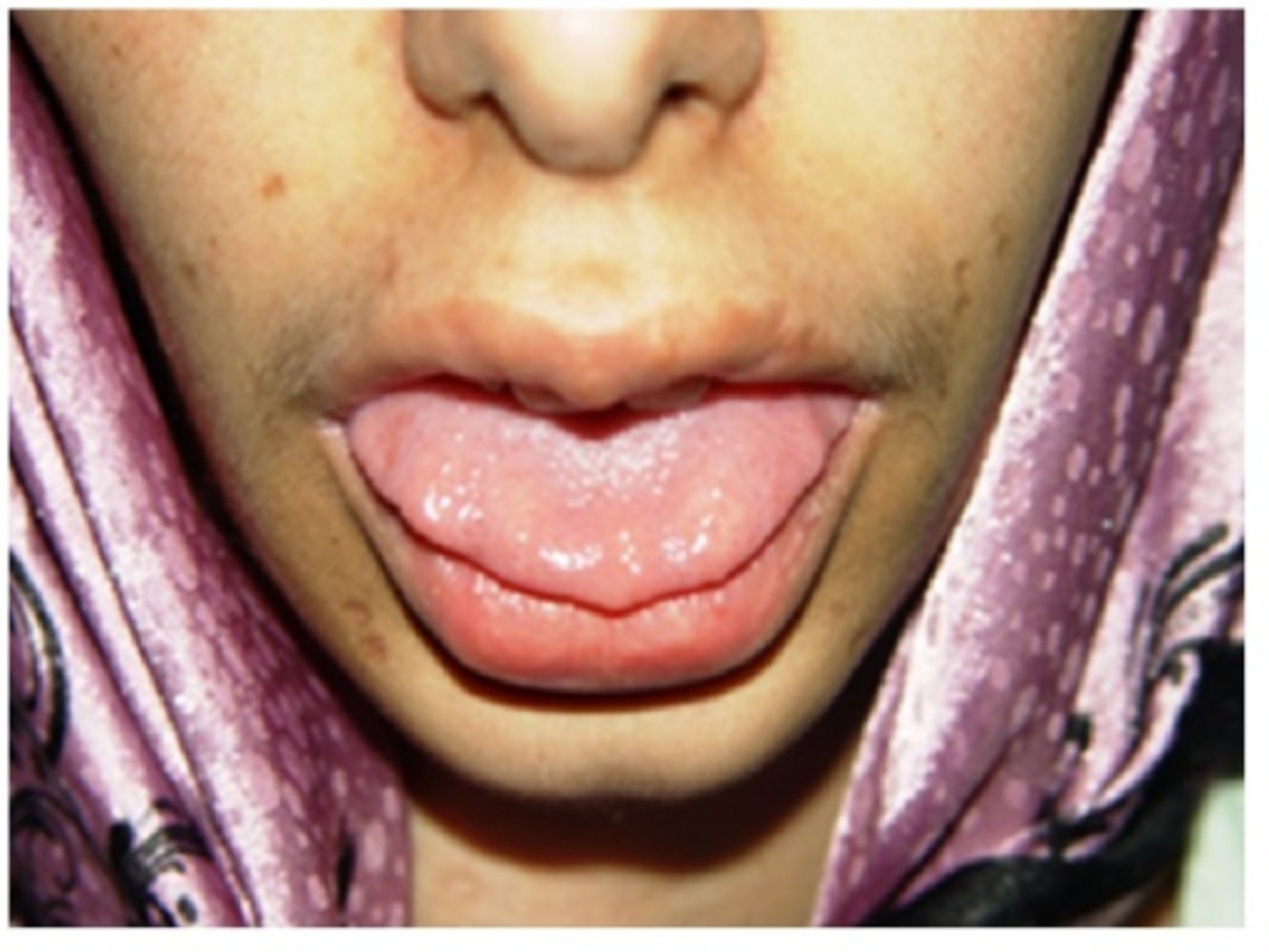 Mucosal neuroma