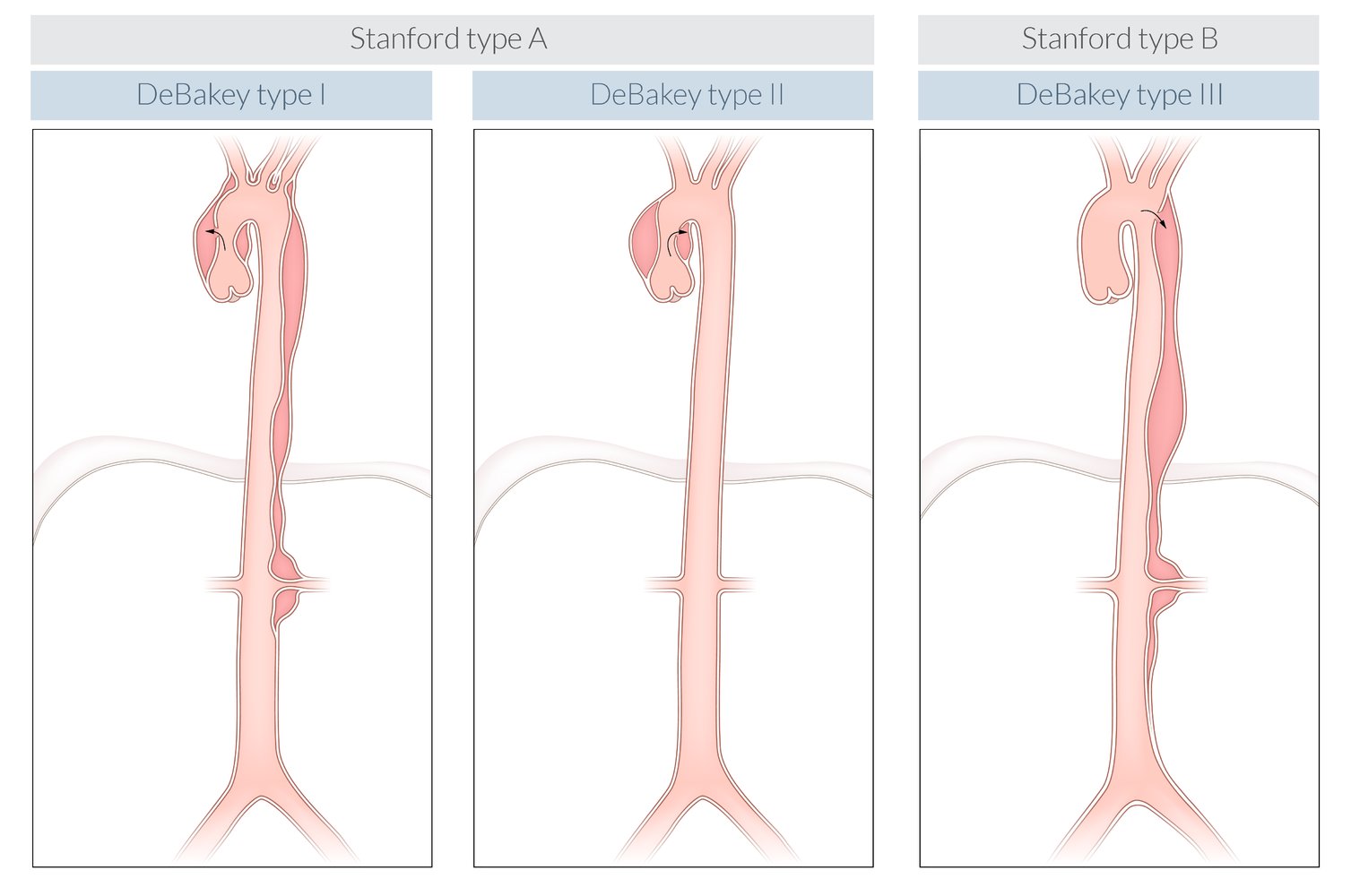 Classifications of aortic dissection