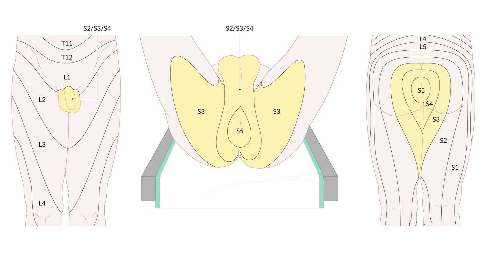 Saddle anesthesia