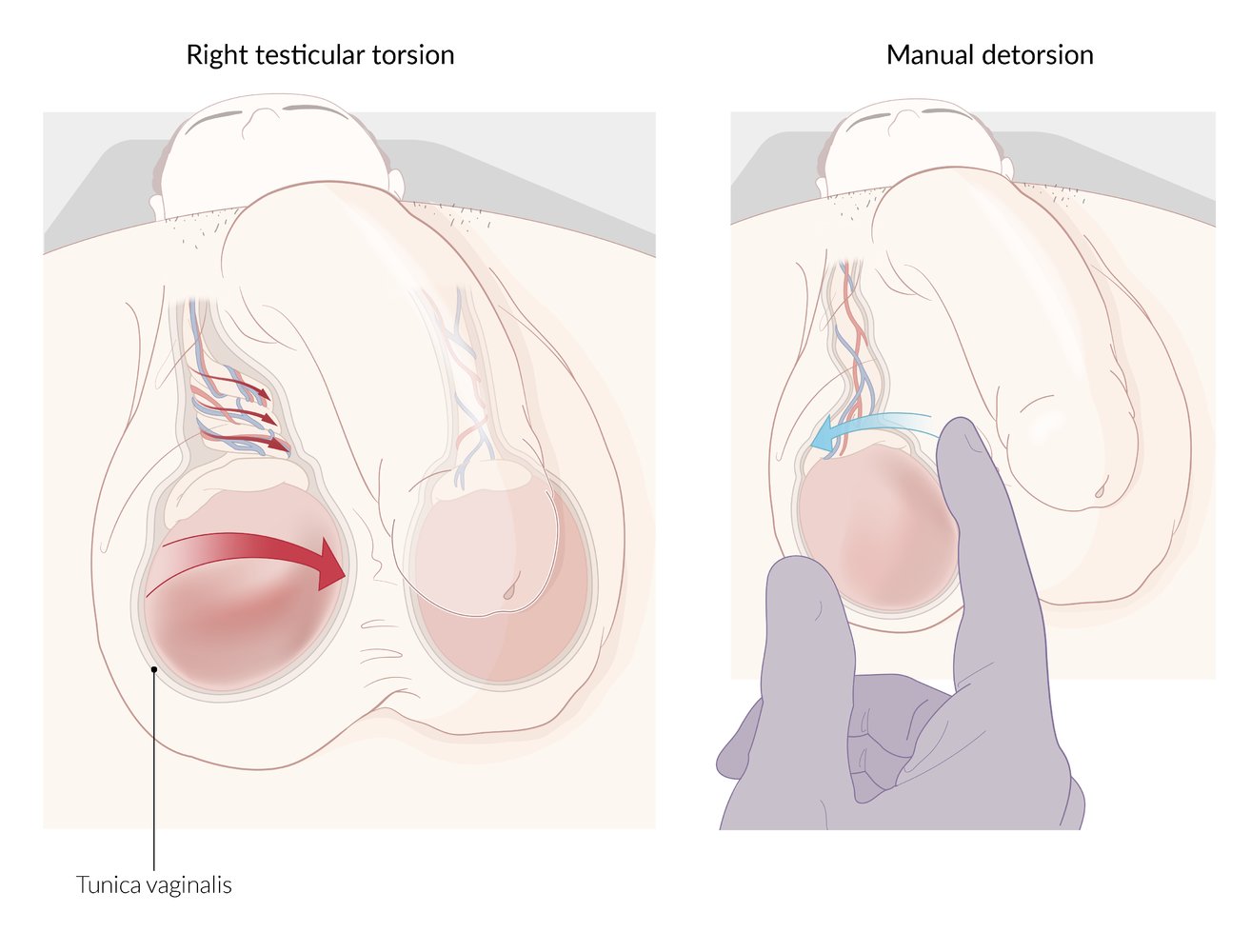 Testicular torsion and manual detorsion