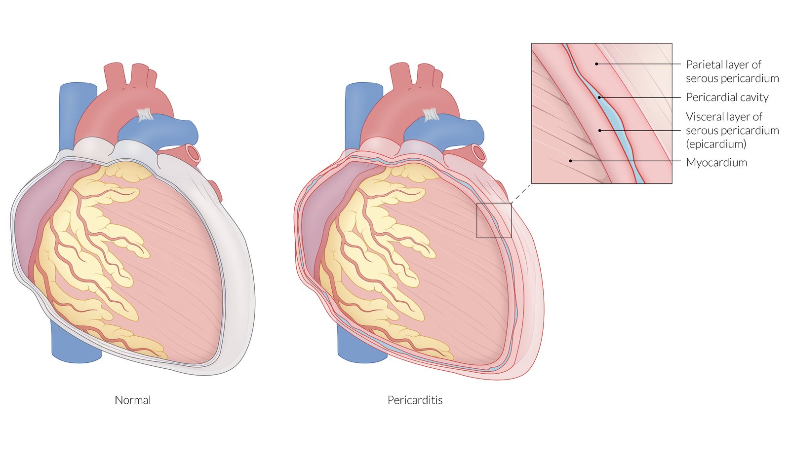 Acute pericarditis