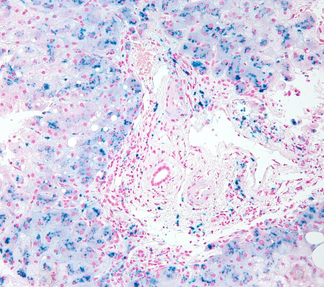 Hemochromatosis