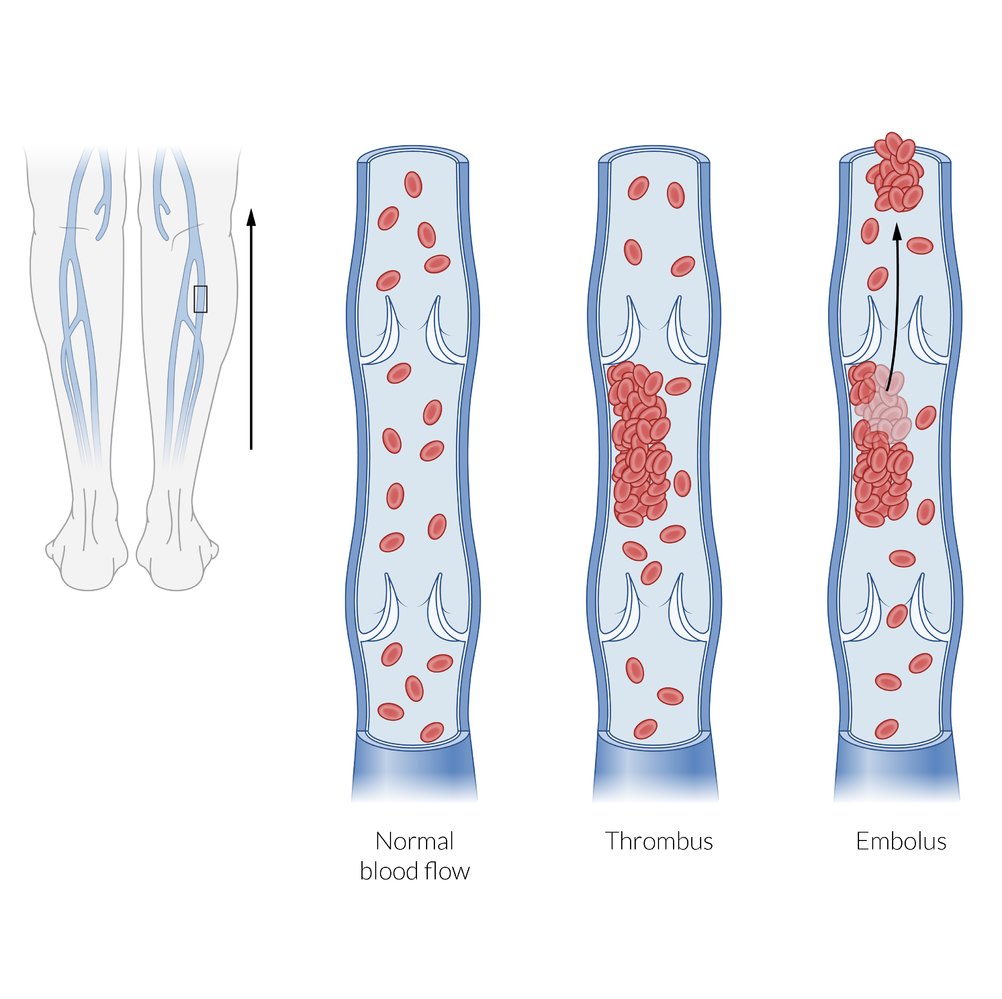 Pulmonary embolism from a deep vein thrombosis