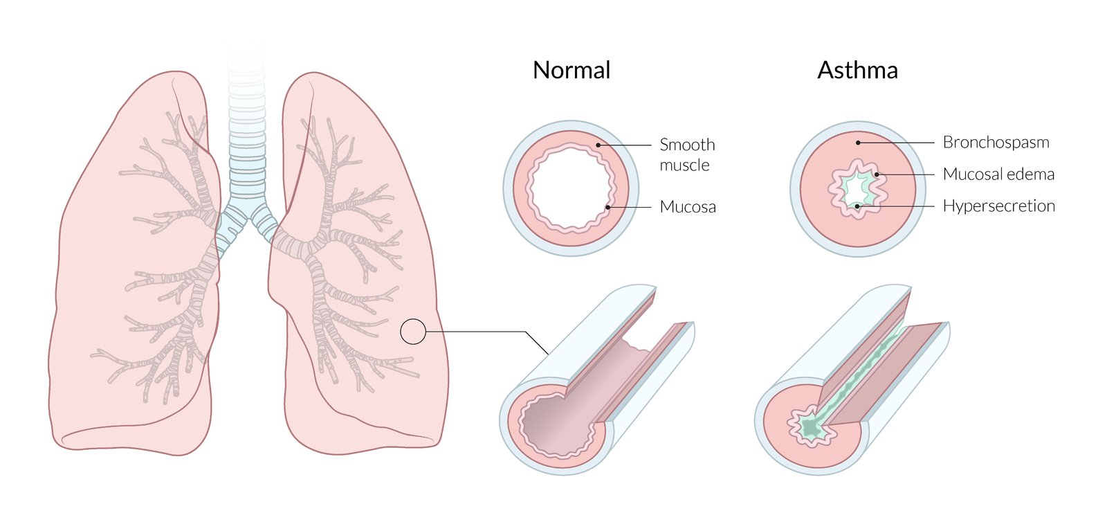 Mechanisms of endobronchial obstruction in asthma