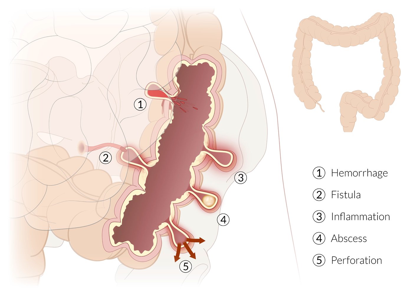 Complications of colonic diverticula