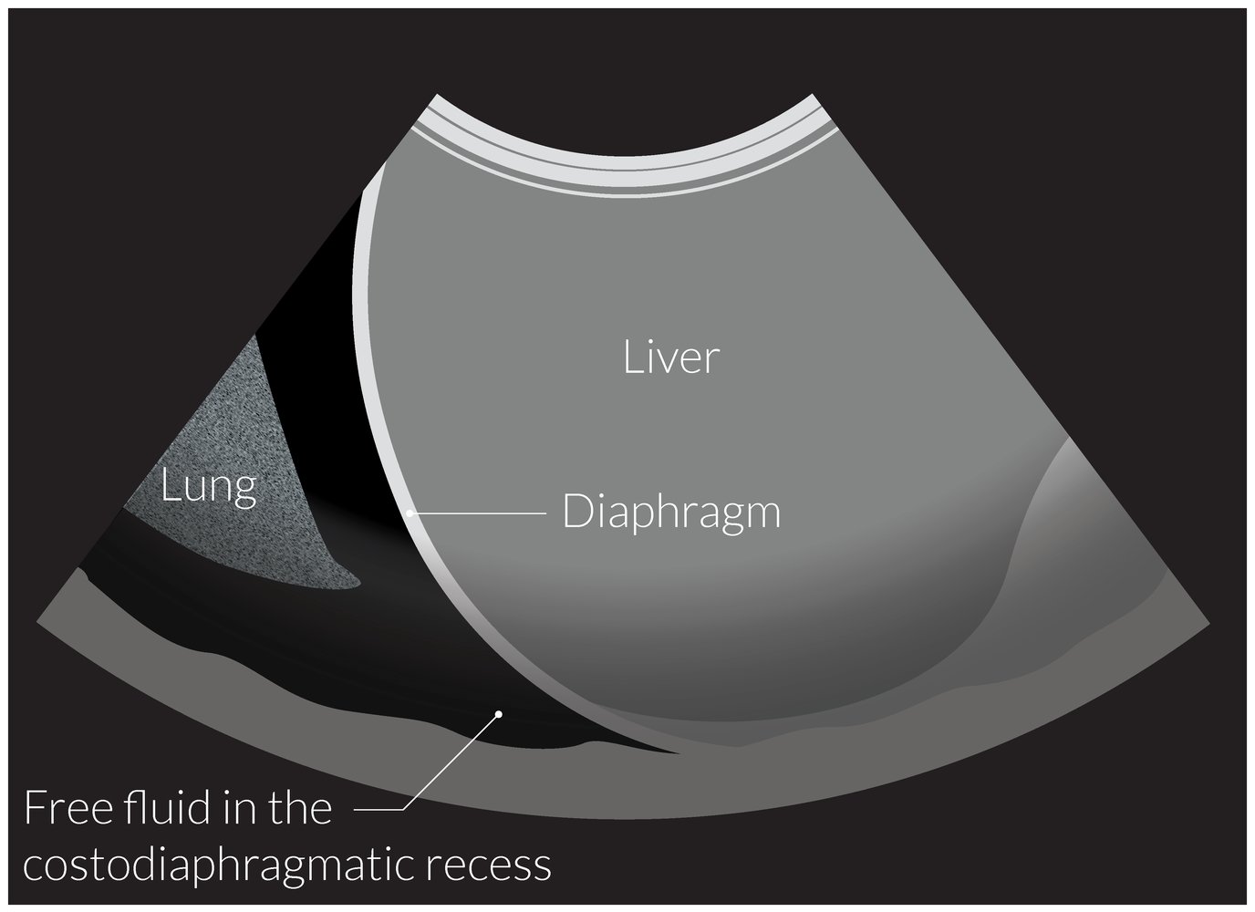Fluid in the right costodiaphragmatic recess