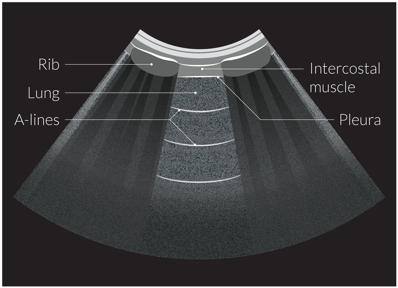 A-lines on lung ultrasound