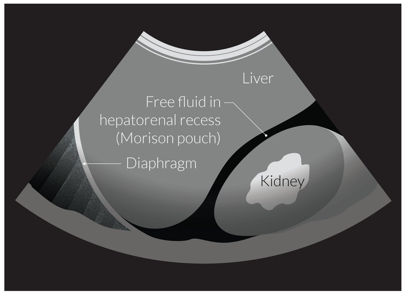 Free fluid in hepatorenal space (Morison pouch)