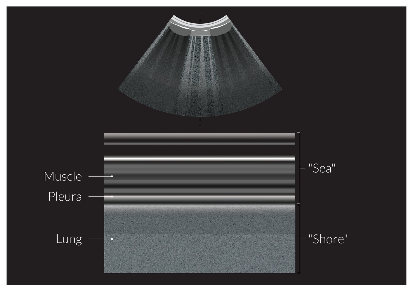 Illustration of seashore sign on lung ultrasound