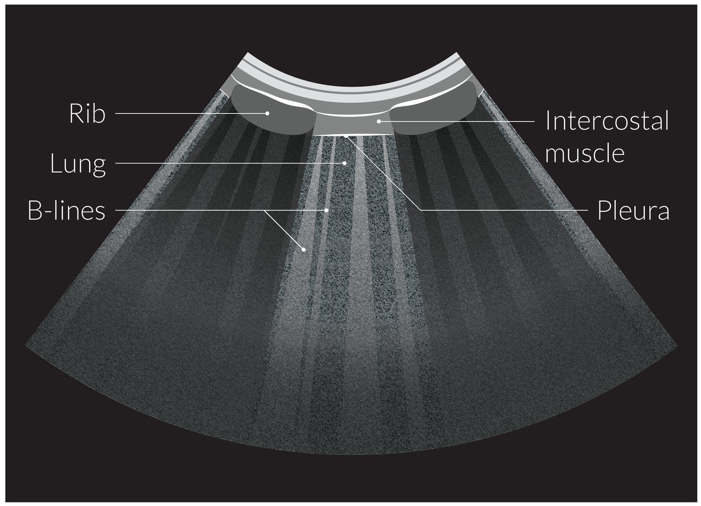 Illustration of B-lines on lung ultrasound