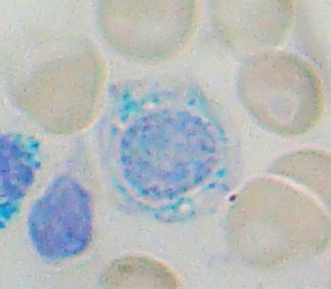 Ringed sideroblast