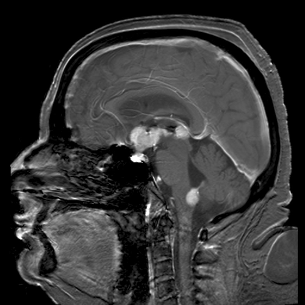 Intracranial masses