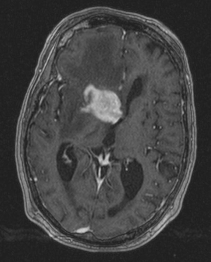 Intracerebral mass with midline shift