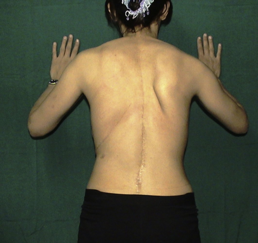 Medial winging of the scapula