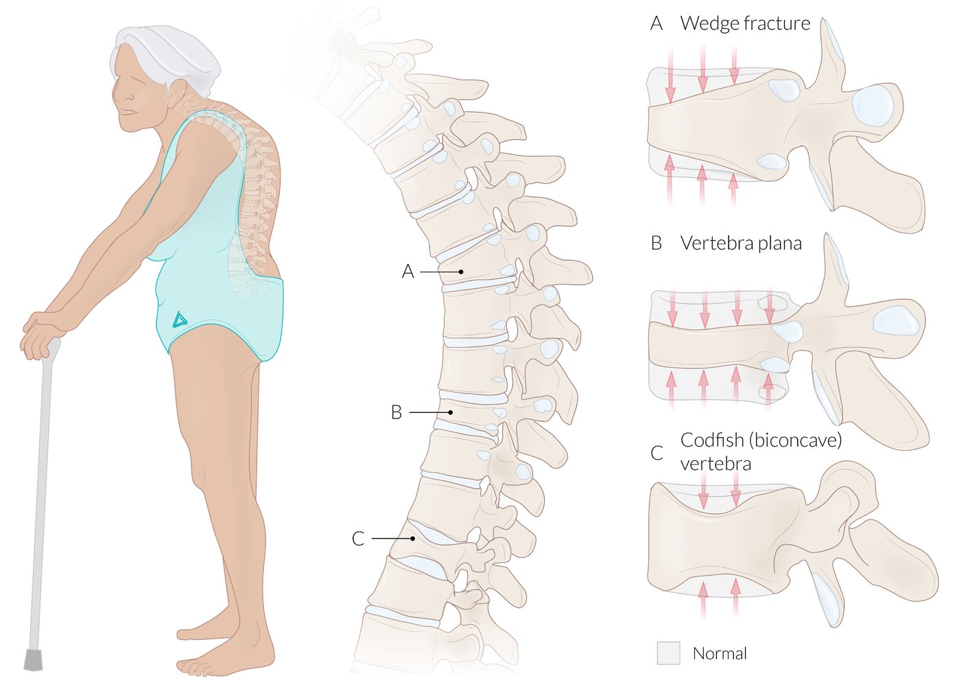 Compression fractures of the vertebra