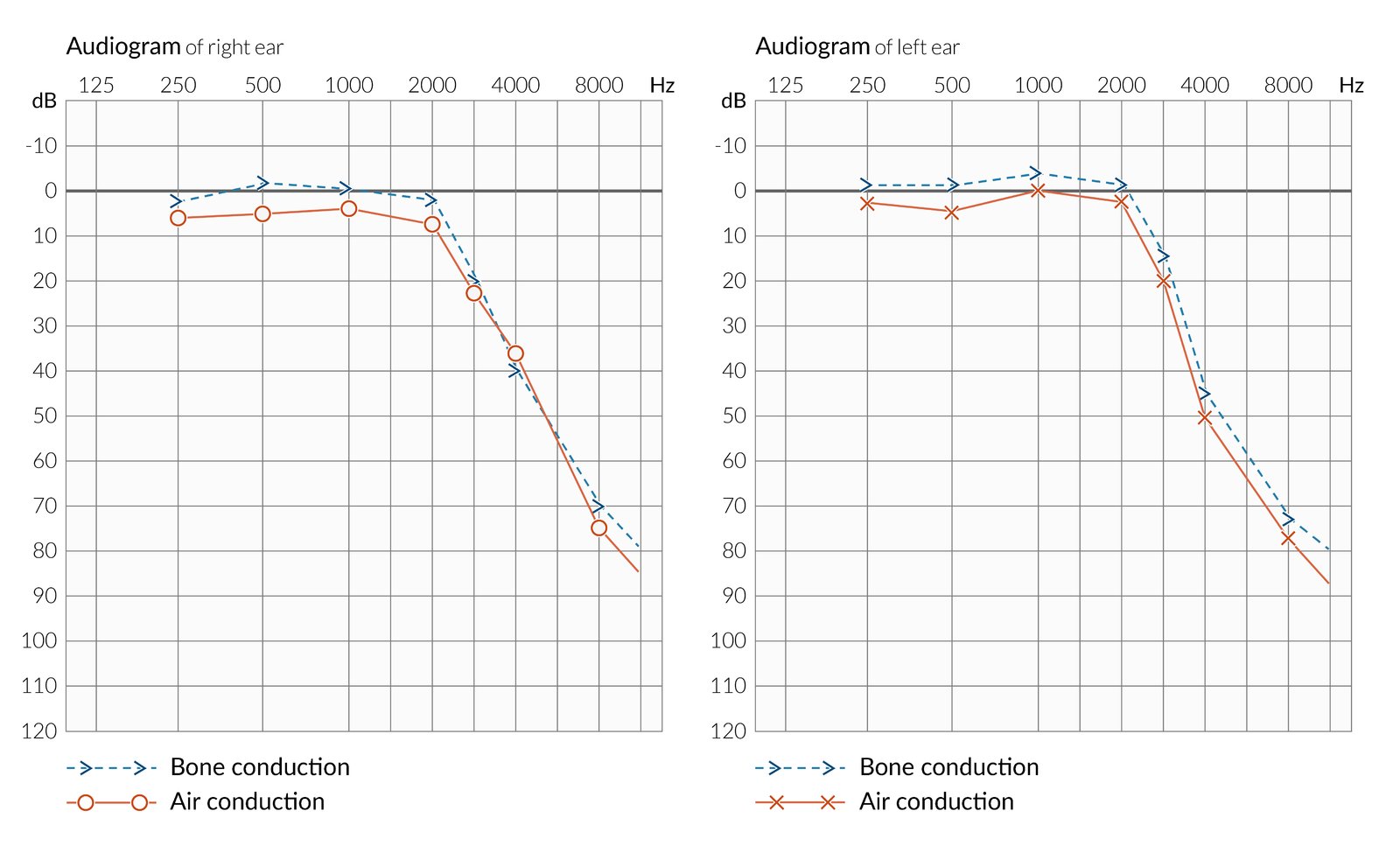 Sensorineural hearing loss