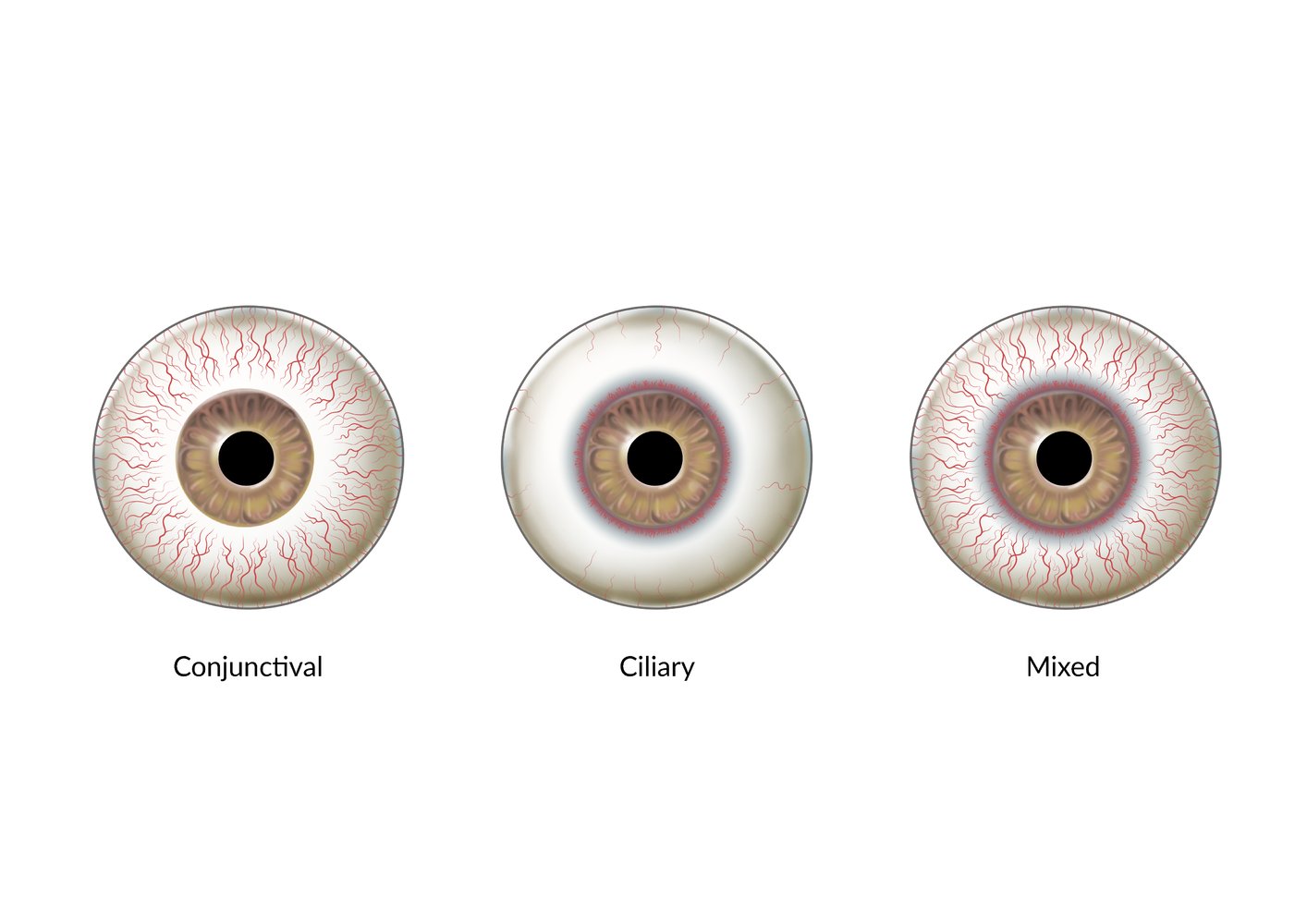 Types of ocular hyperemia (red eye)
