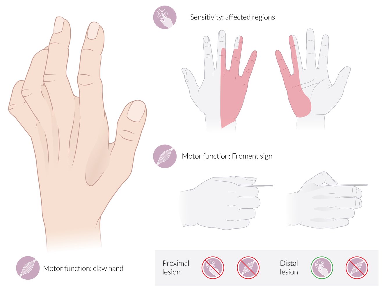 Ulnar nerve neuropathy