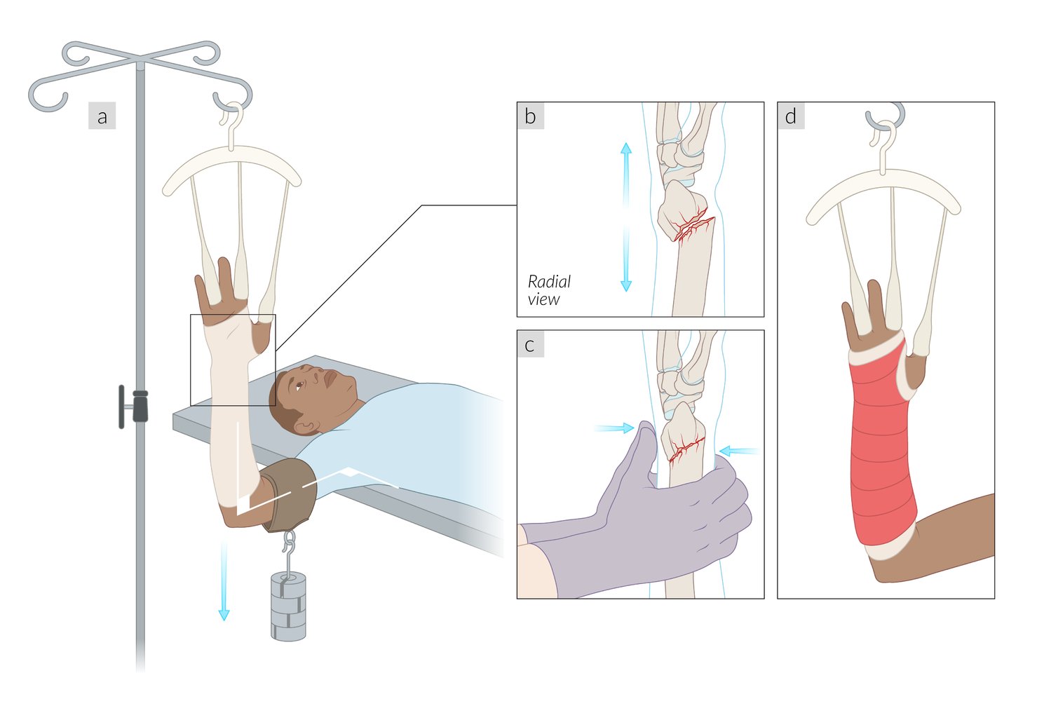 Distal radius fracture reduction using finger trap