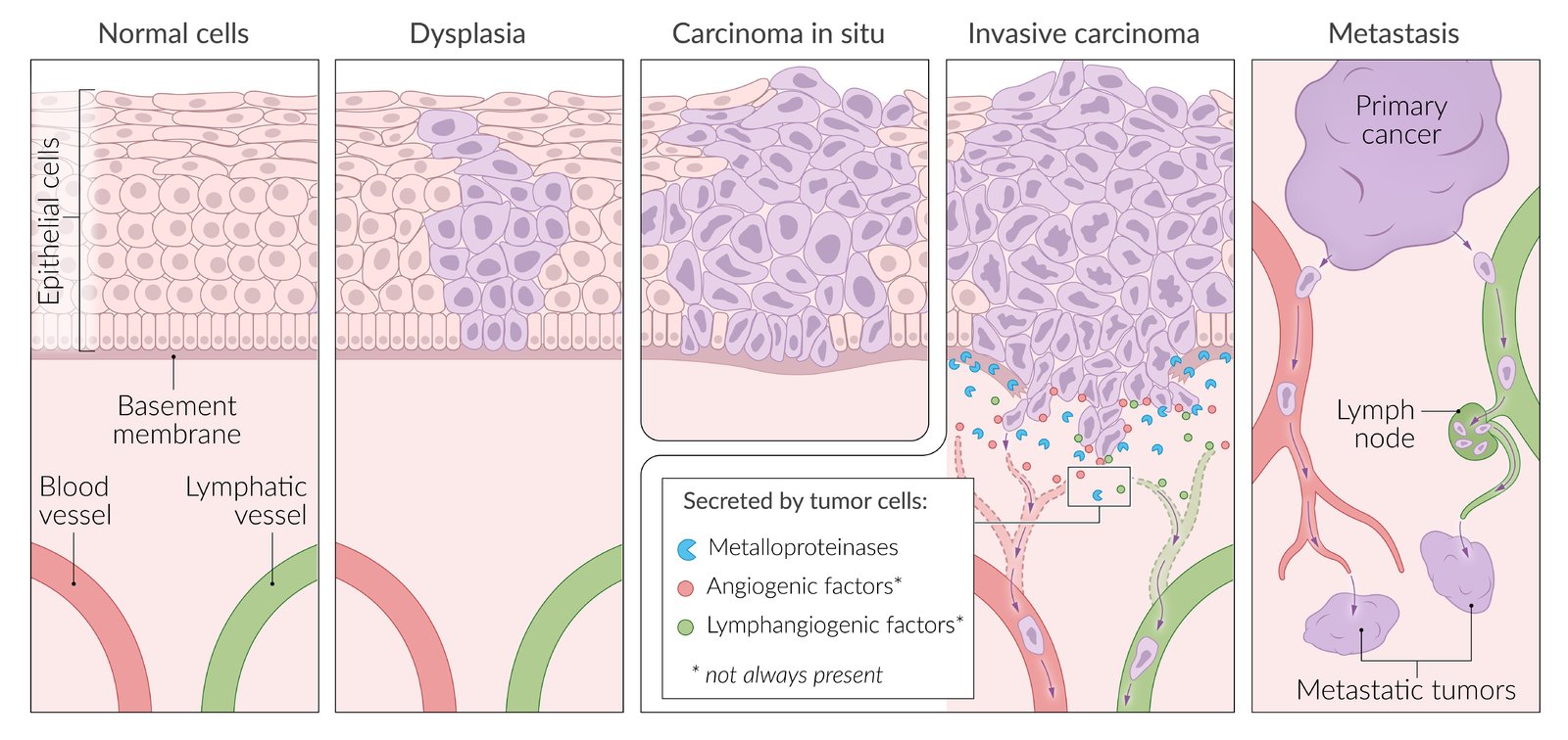 Neoplastic progression