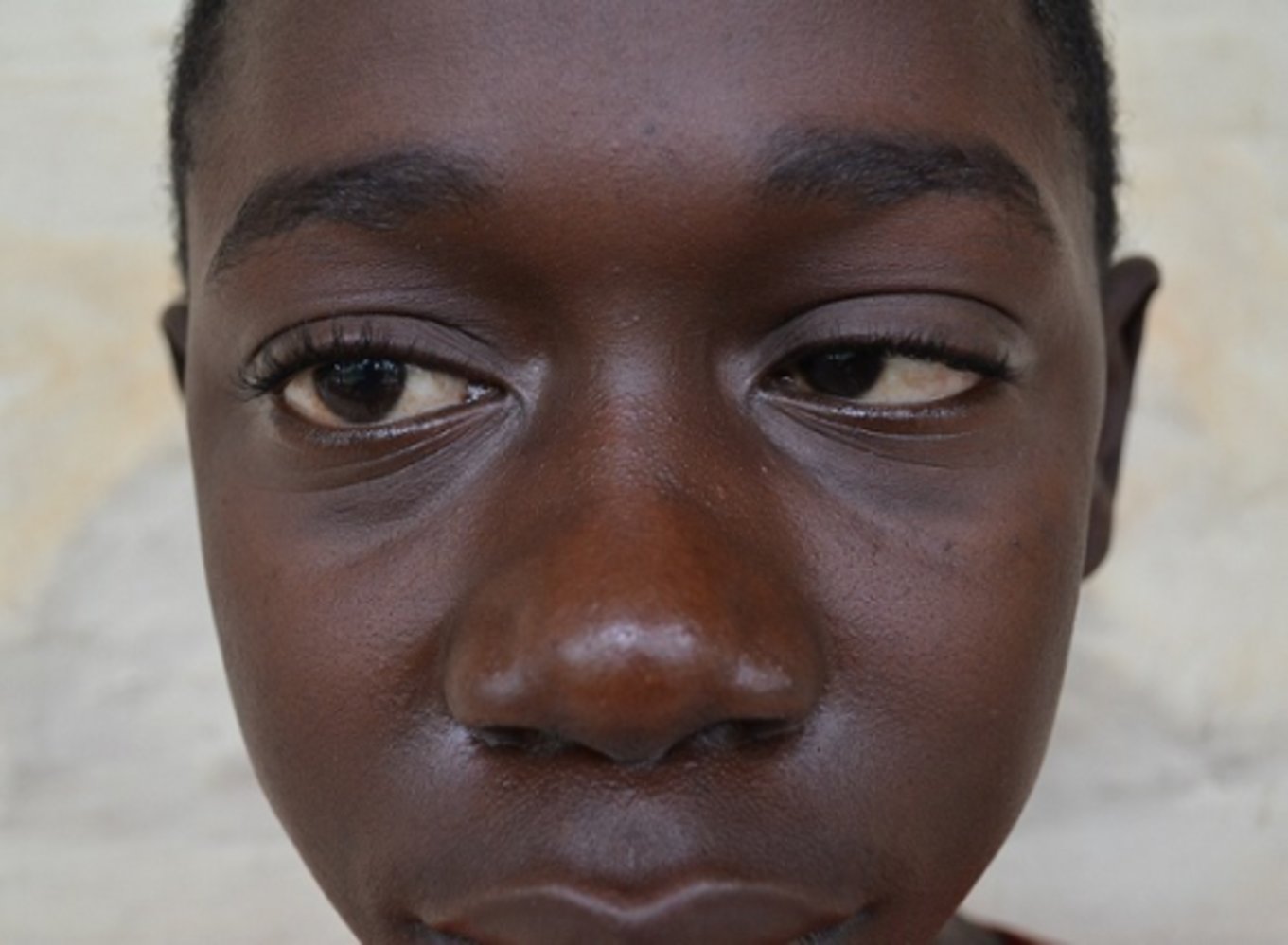Abducens nerve palsy