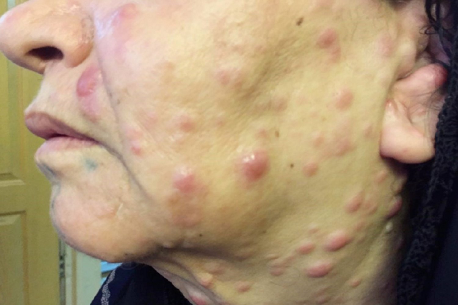 Leukemia cutis