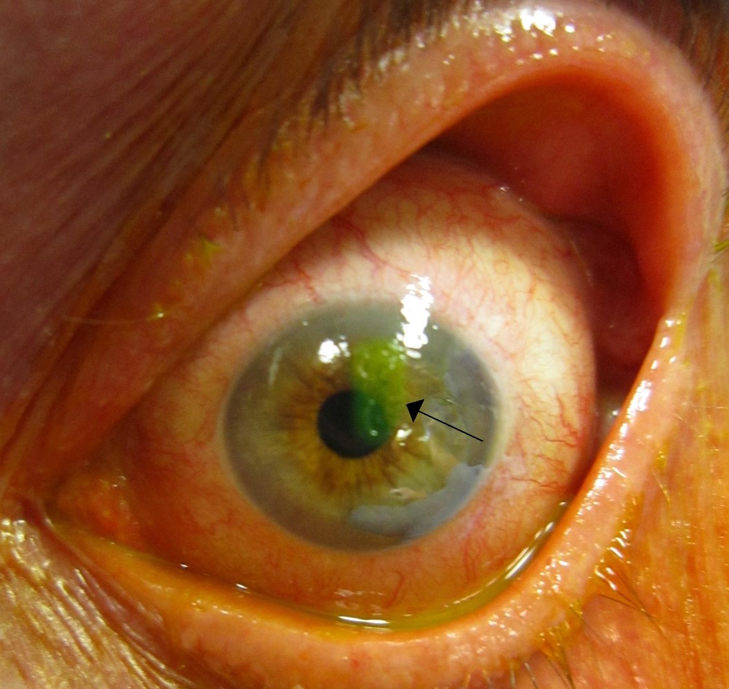 Corneal abrasion highlighted by fluorescein staining