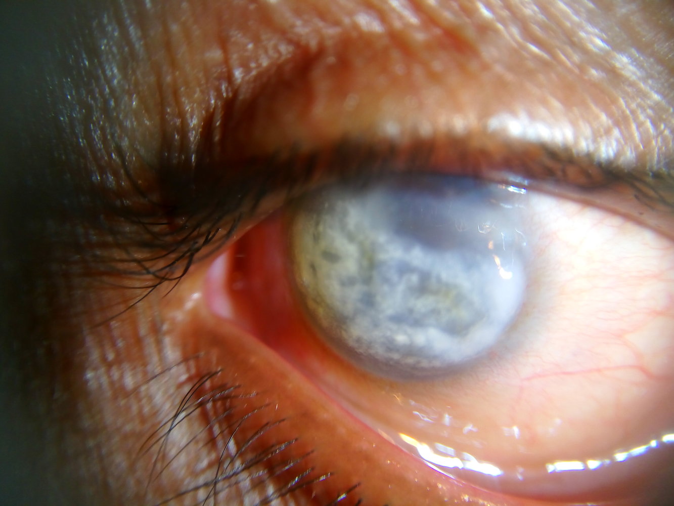 Band keratopathy