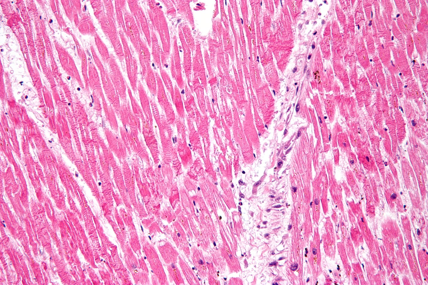Contraction band necrosis