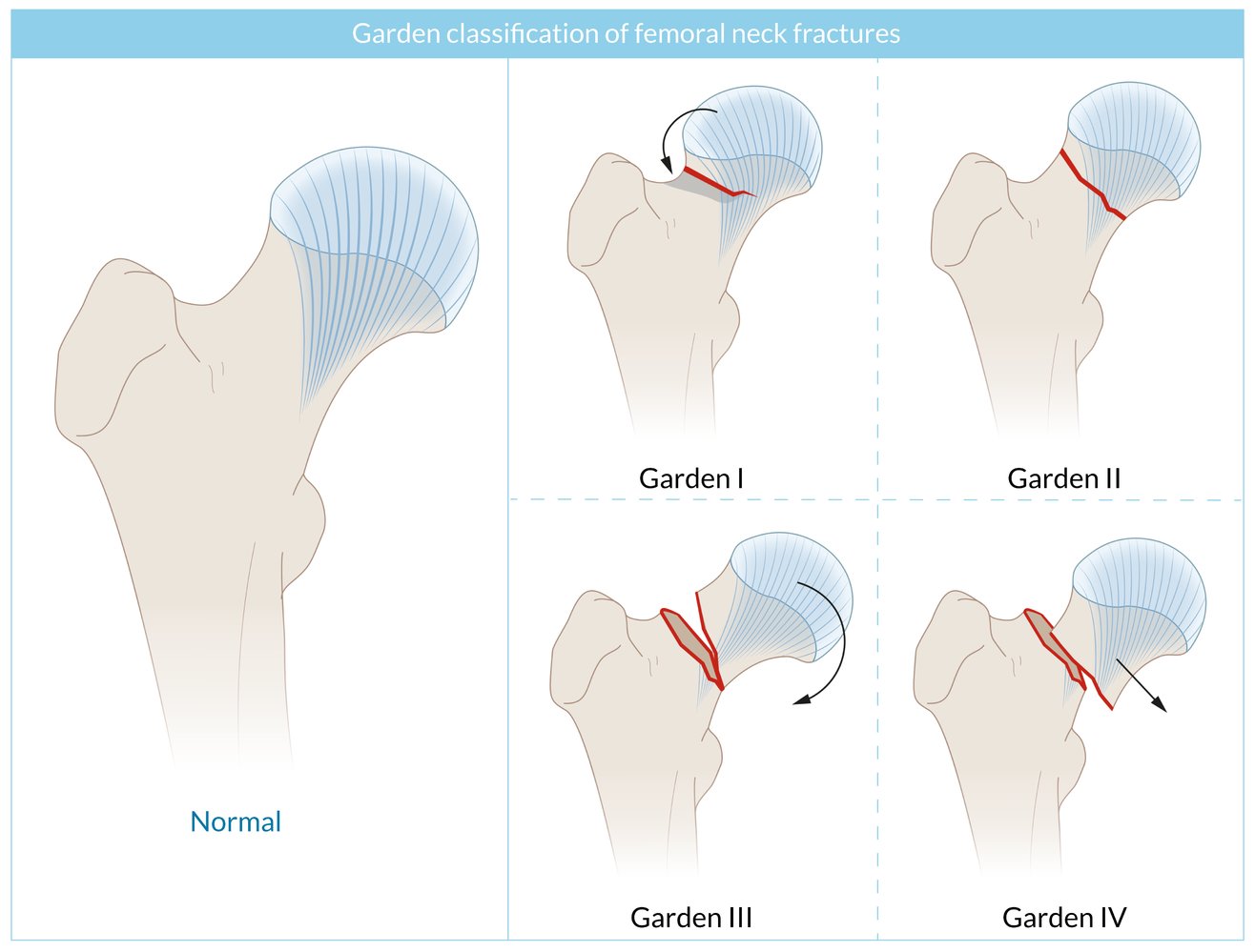 Garden classification of femoral neck fractures