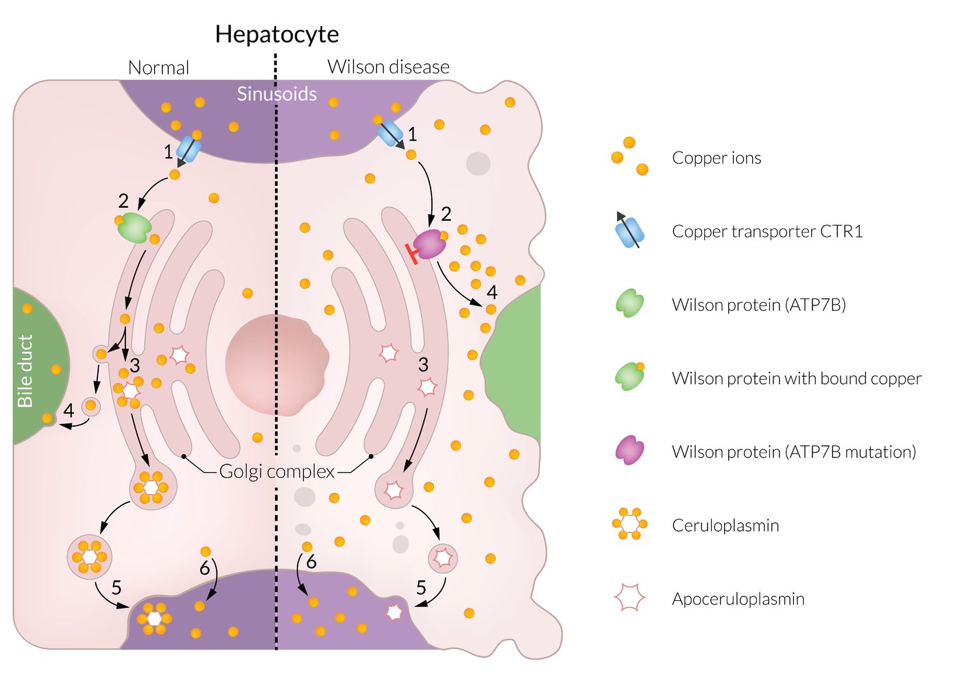 Copper metabolism in normal hepatocyte and hepatocyte affected by Wilson disease