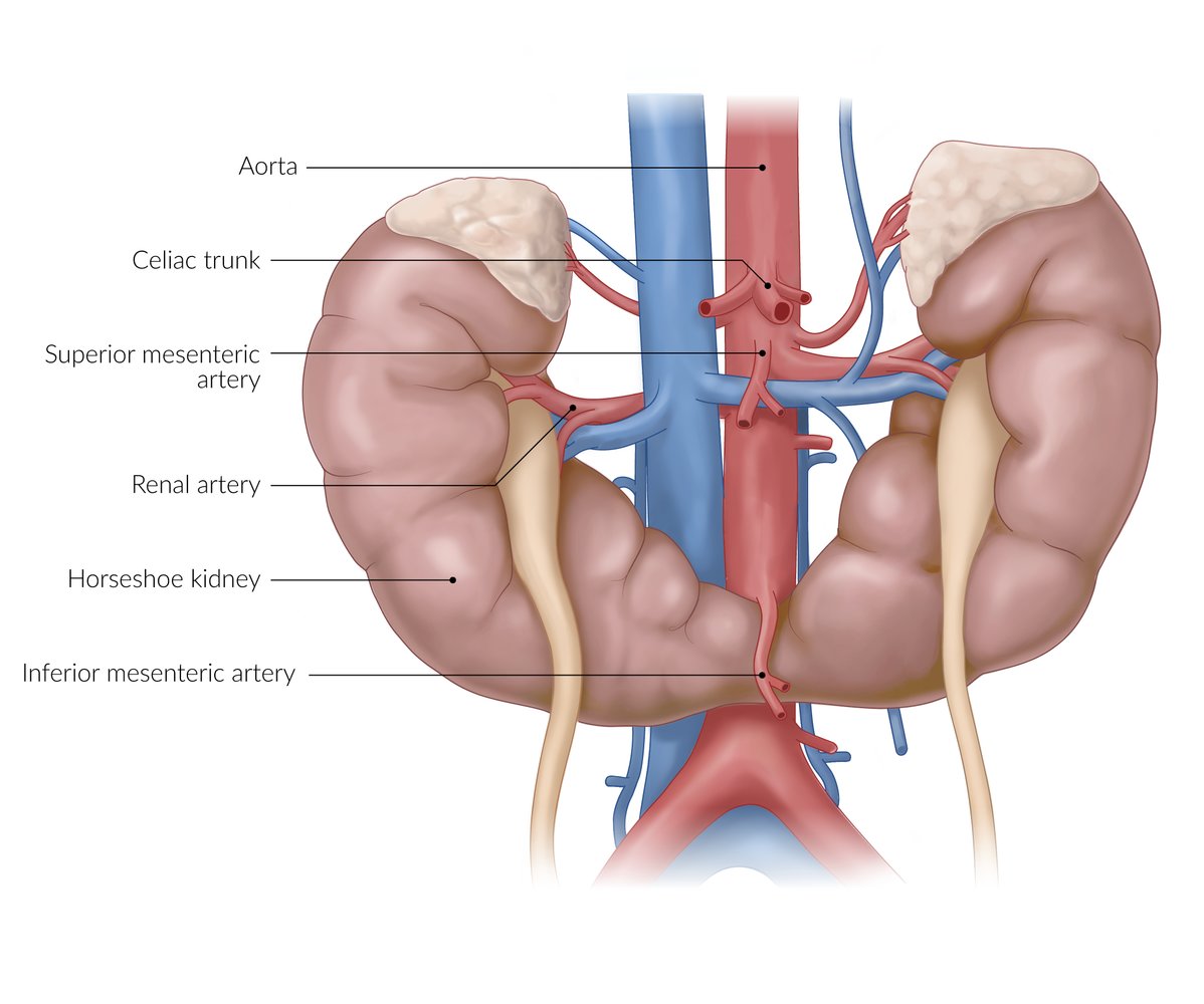 Horseshoe kidney