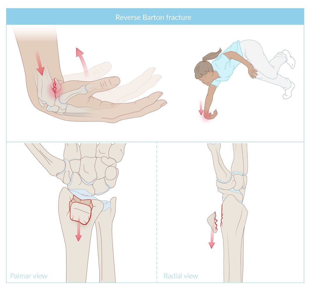 Reverse Barton fracture