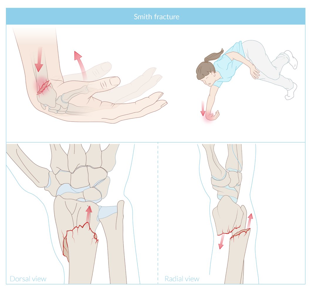 Smith fracture