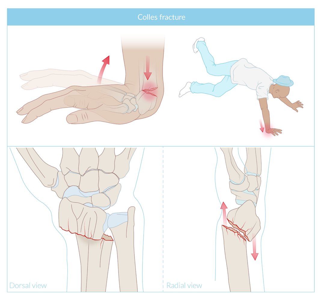 Colles fracture (distal radius fracture)