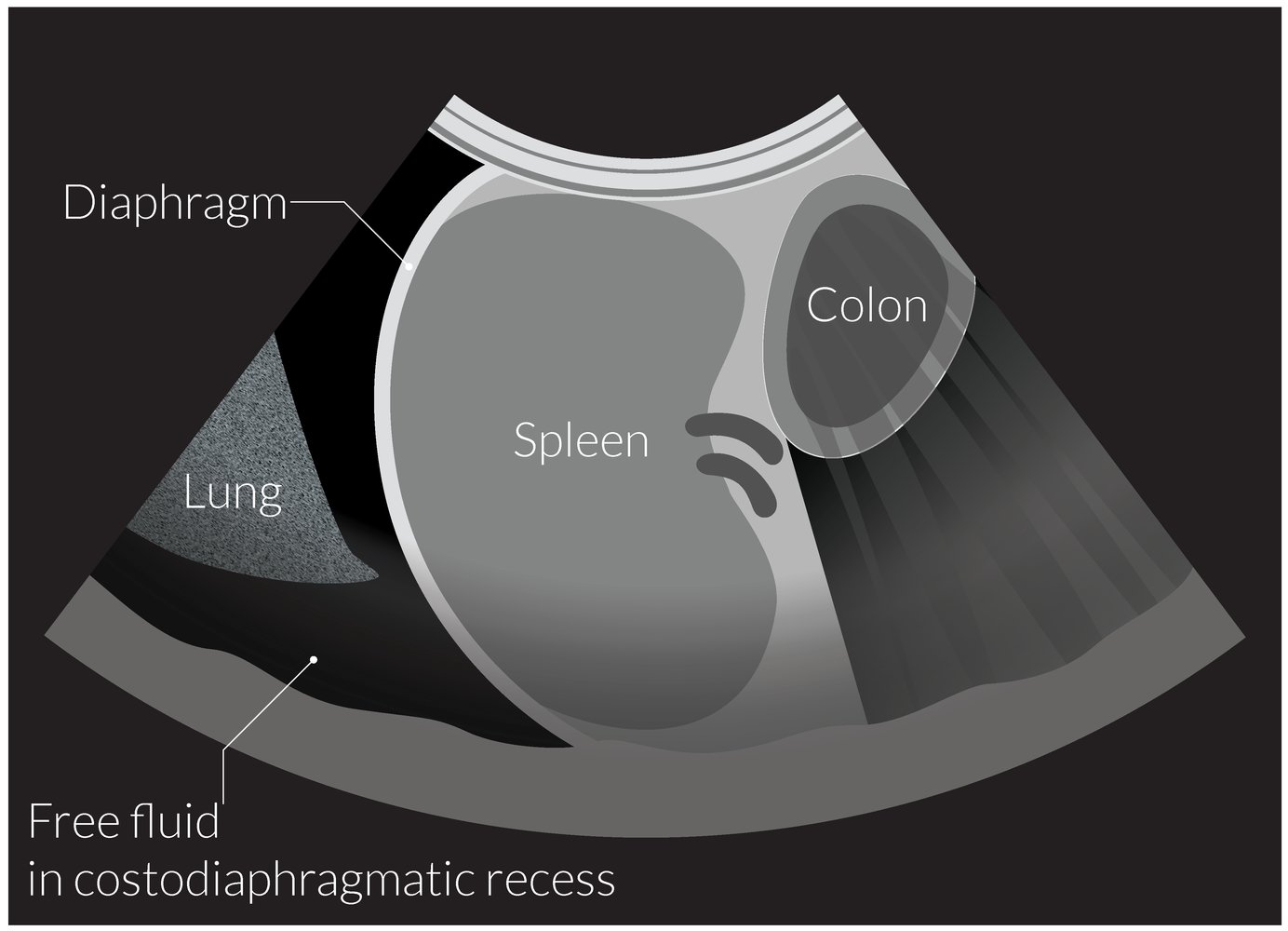 Fluid in the left costodiaphragmatic recess