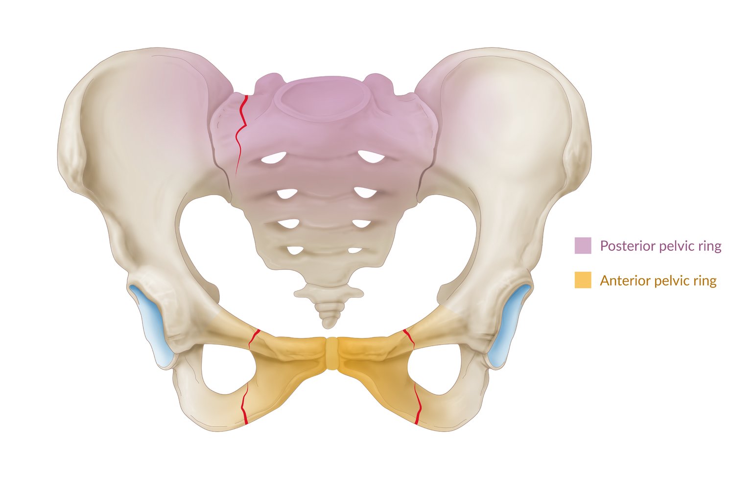 Fractures of the pelvis