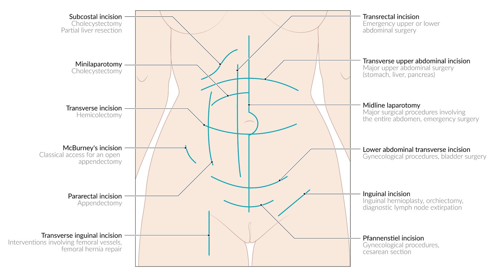Important abdominal and inguinal incision sites and potential indications