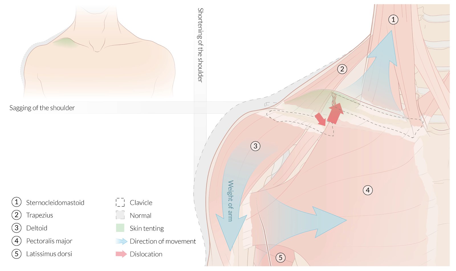Clavicle fracture