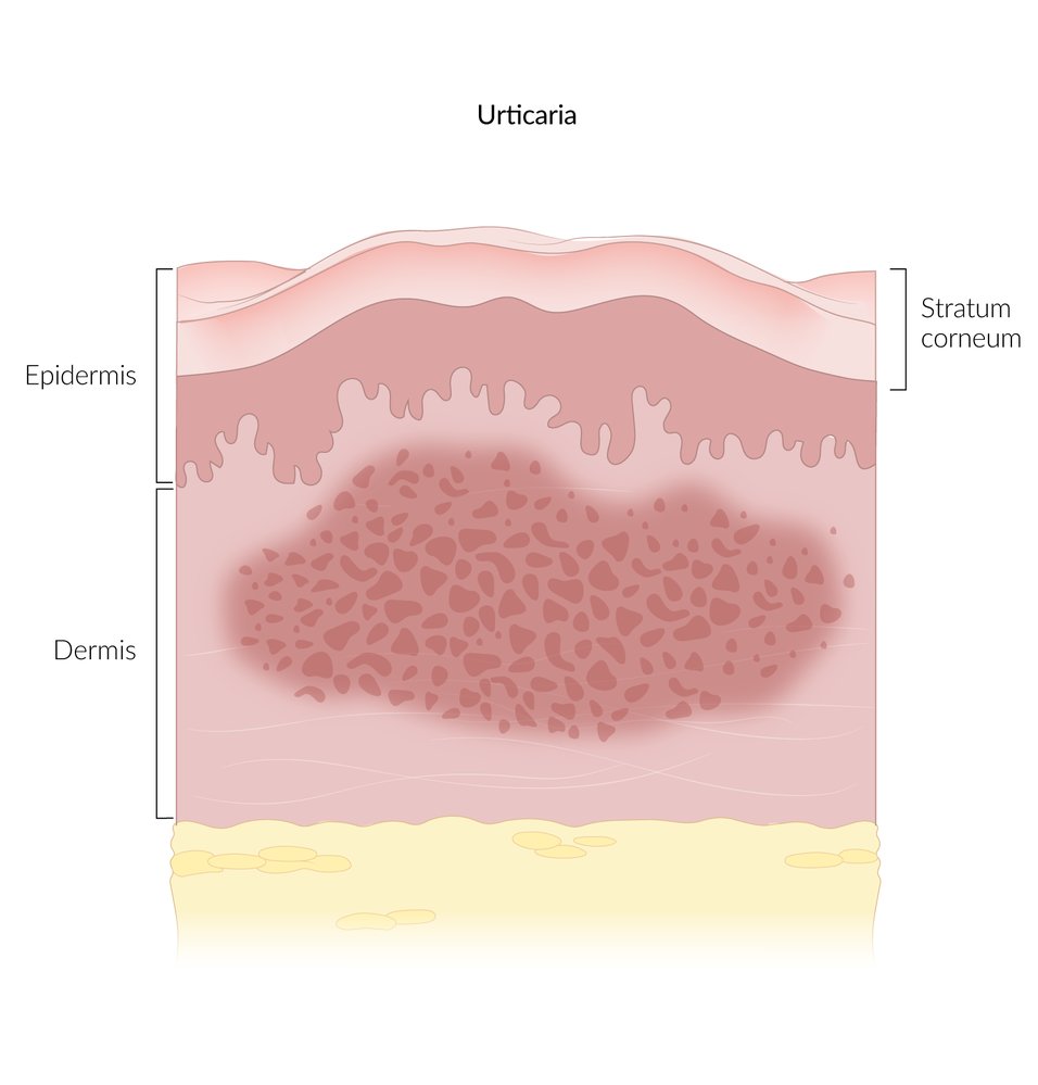 Urticaria (primary lesion)