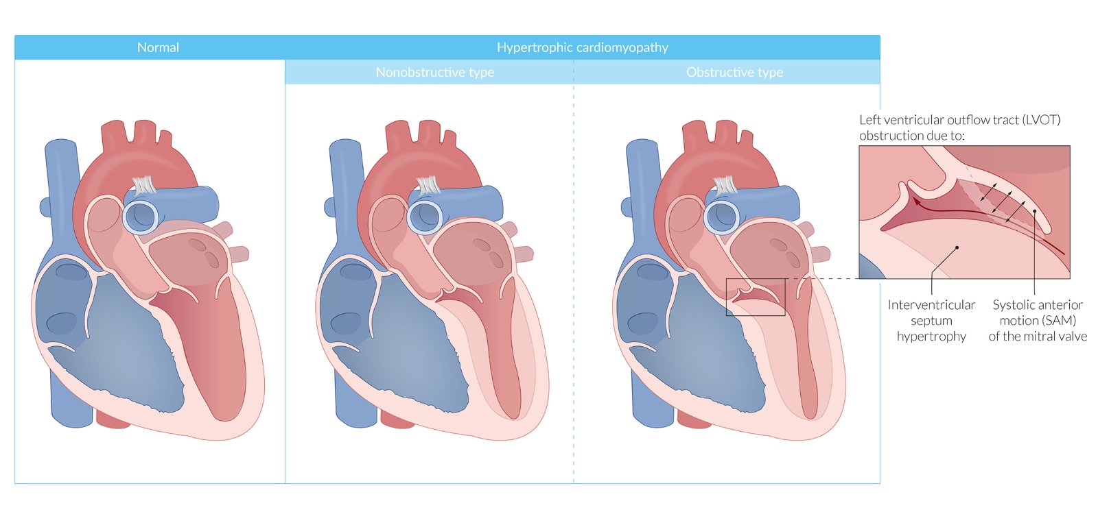 Hypertrophic cardiomyopathy
